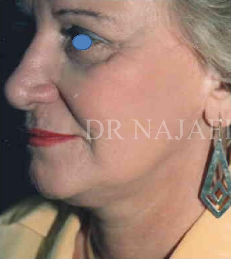 Facelift before — Dr. Hossein Najafi