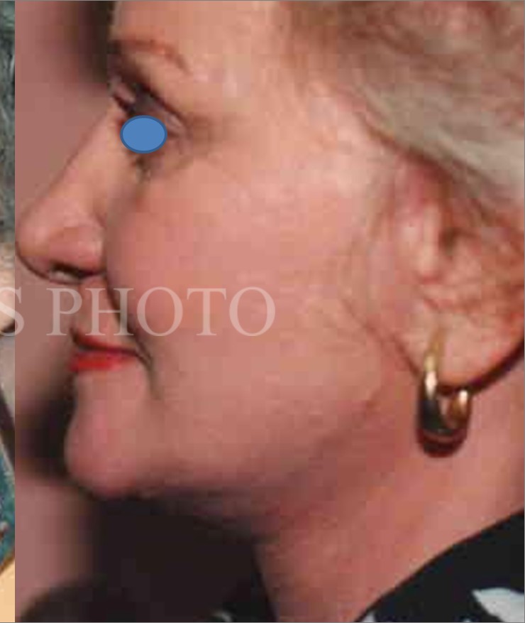 Facelift after — Dr. Hossein Najafi