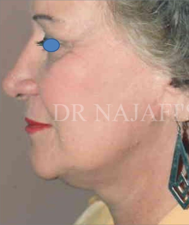 Facelift before — Dr. Hossein Najafi