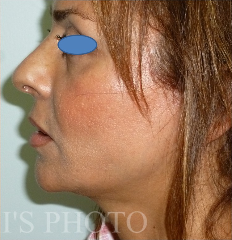 Facelift after — Dr. Hossein Najafi