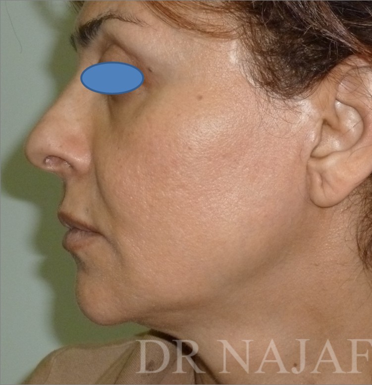 Facelift before — Dr. Hossein Najafi