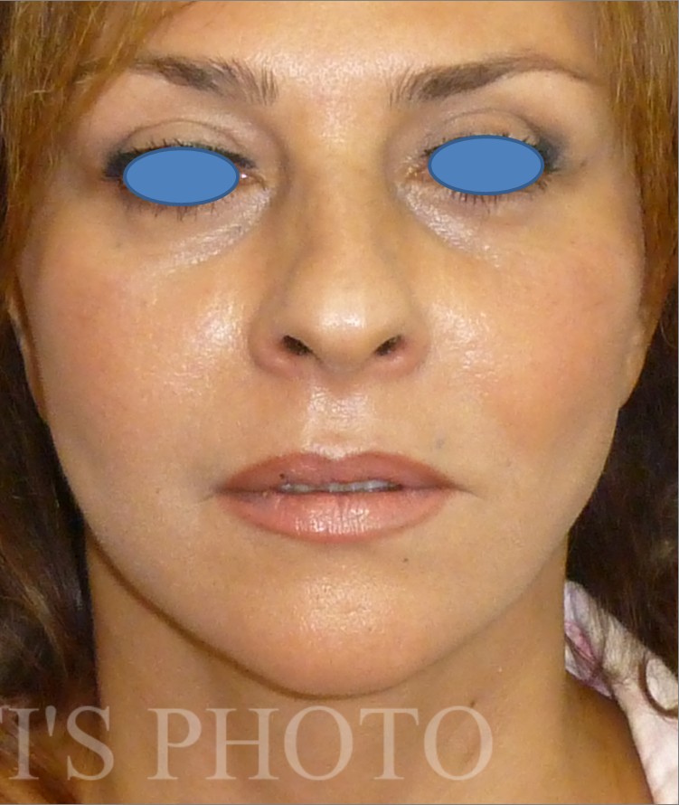 Facelift after — Dr. Hossein Najafi