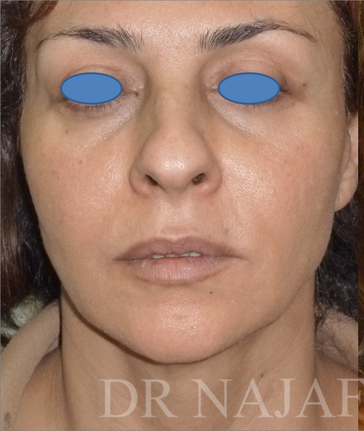 Facelift before — Dr. Hossein Najafi