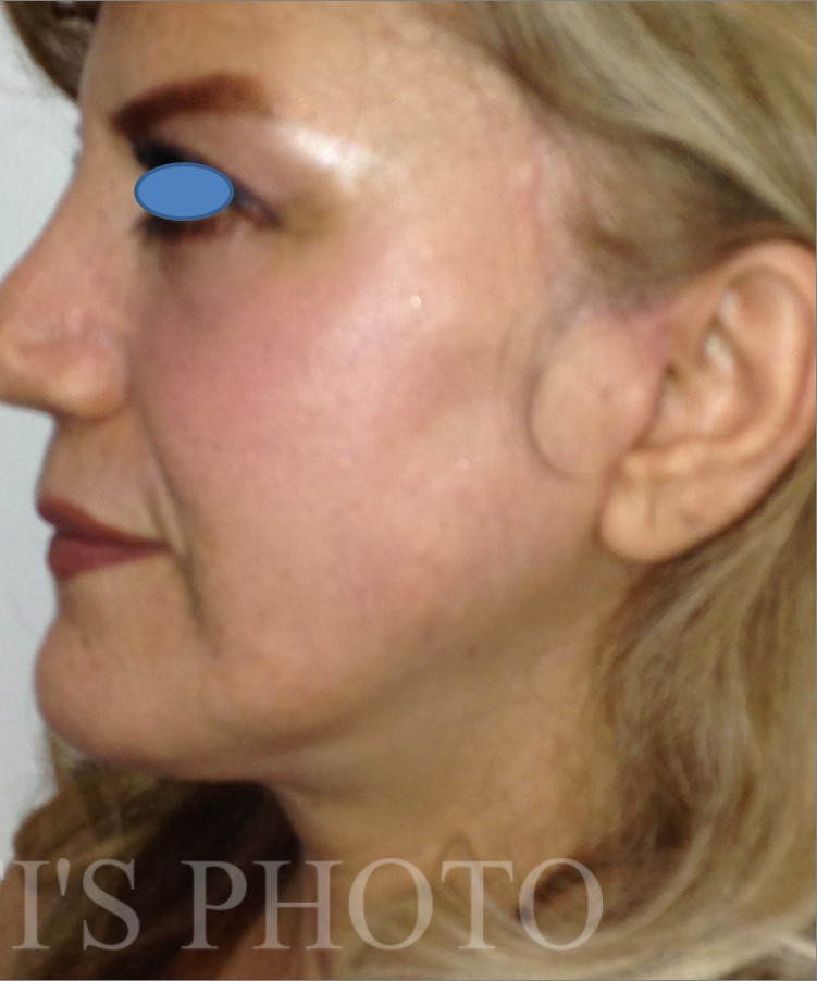 Facelift after — Dr. Hossein Najafi