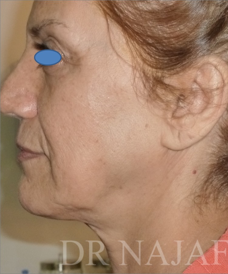 Facelift before — Dr. Hossein Najafi