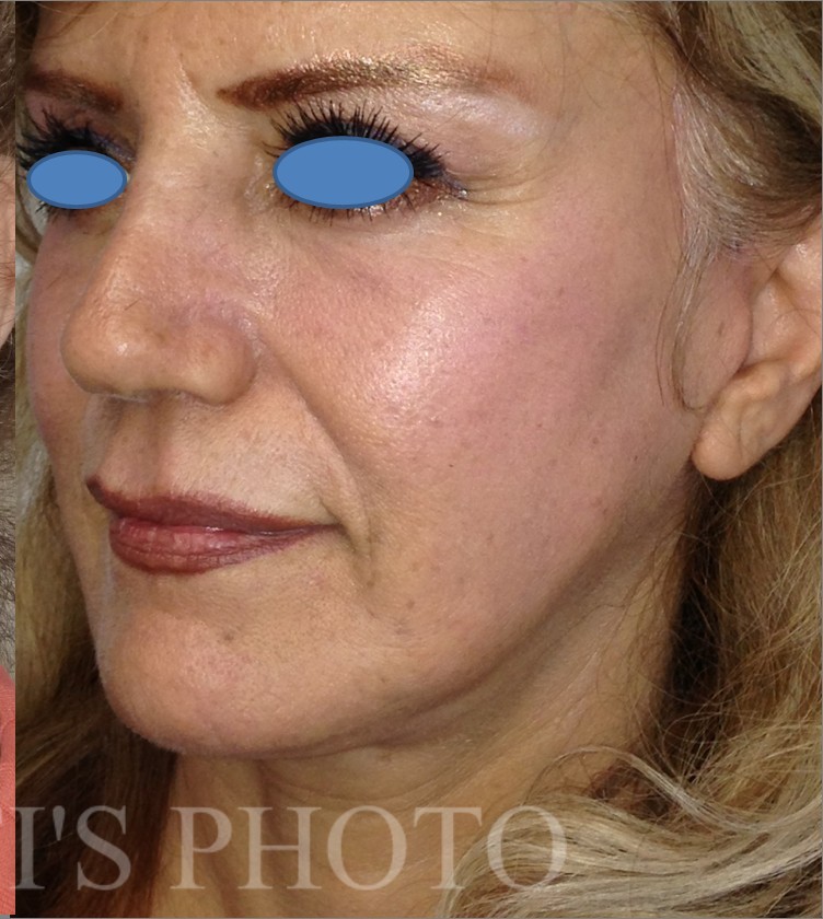 Facelift after — Dr. Hossein Najafi
