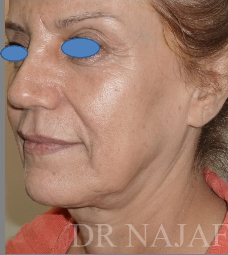 Facelift before — Dr. Hossein Najafi