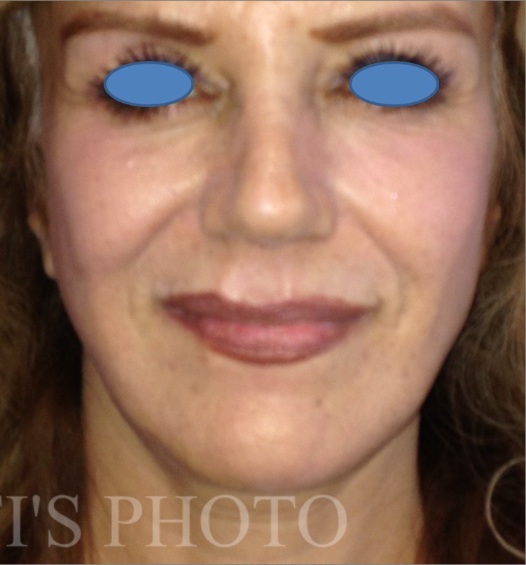 Facelift after — Dr. Hossein Najafi