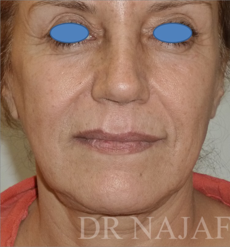 Facelift before — Dr. Hossein Najafi