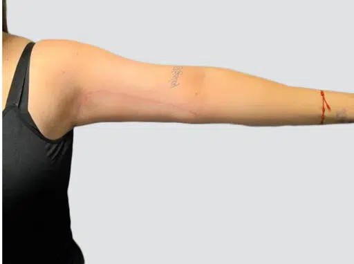 Arm Lift before and after - after