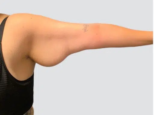 Arm Lift before and after - before