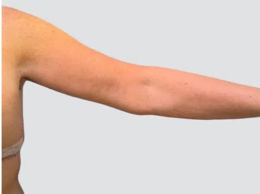 Arm Lift before and after - after