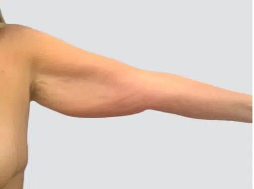 Arm Lift before and after - before