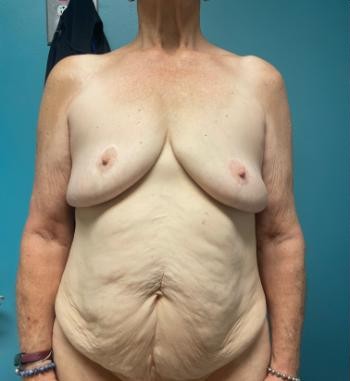 Breast Augmentation before and after - before