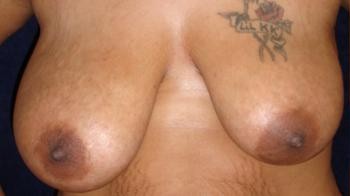 Breast Lift before and after - before