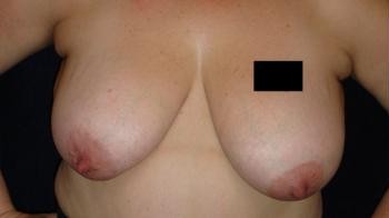Breast Lift before and after - before