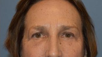 Brow Lift before and after - after