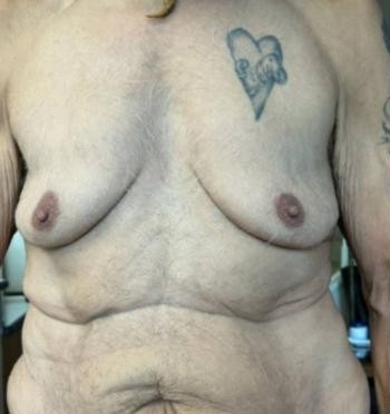 Body Contouring before and after - before