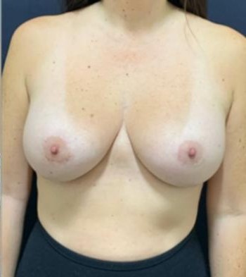 Breast Augmentation before and after - after