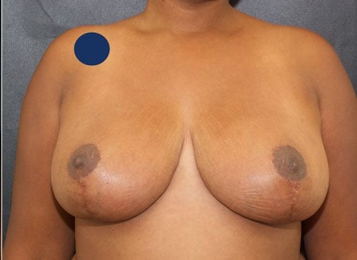 Breast Augmentation Patient 5 before and after - after