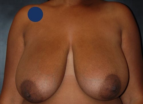 Breast Augmentation Patient 5 before and after - before