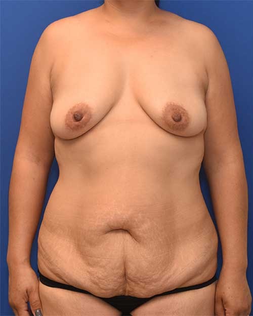 Breast Reduction Patient 1 before and after - before