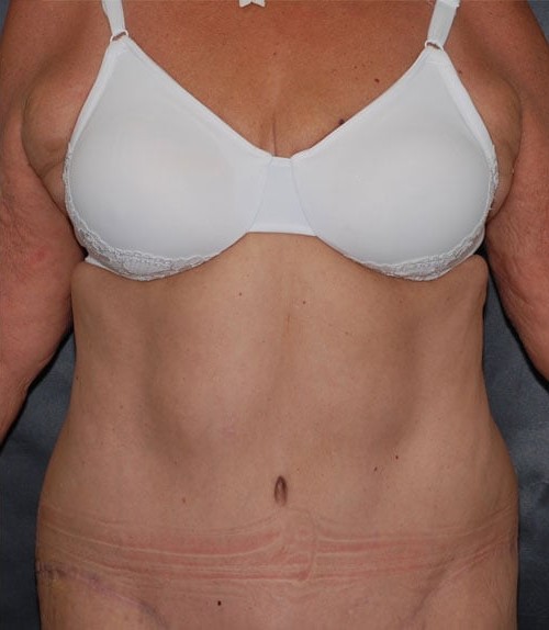 Tummy Tuck (Abdominoplasty) and Breast Augmentation before and after - after
