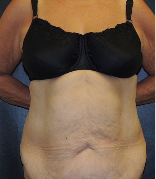 Tummy Tuck (Abdominoplasty) and Breast Augmentation before and after - before