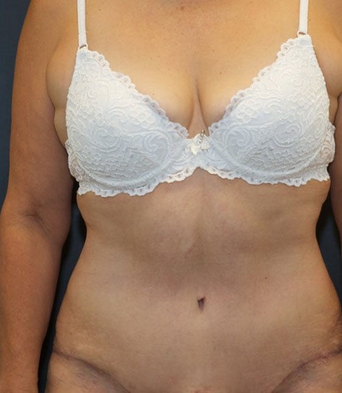 Tummy Tuck (Abdominoplasty) before and after - after
