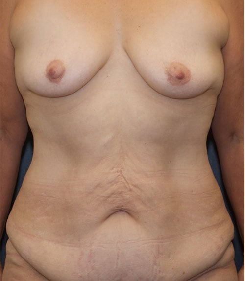 Tummy Tuck (Abdominoplasty) before and after - before
