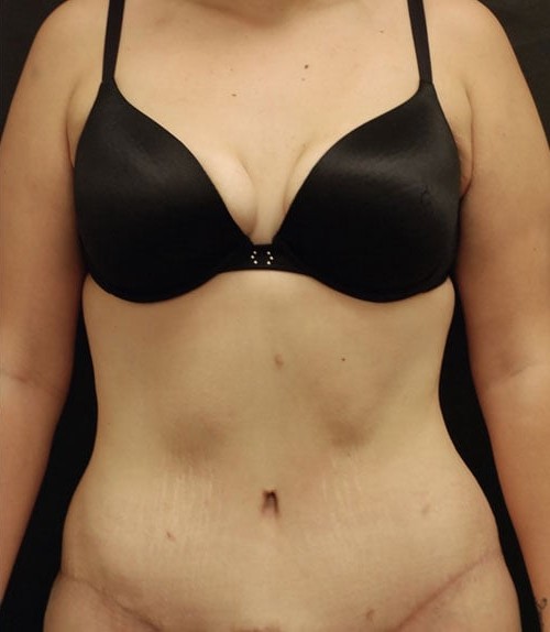 Tummy Tuck (Abdominoplasty) before and after - after