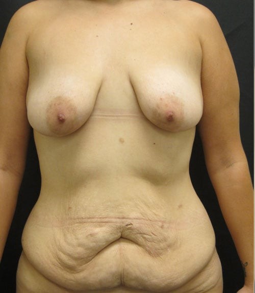 Tummy Tuck (Abdominoplasty) before and after - before