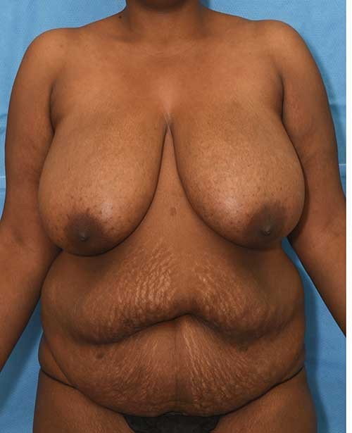 Brazilian Butt Lift, Liposuction before and after - before