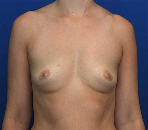 Breast Augmentation + Breast Lift (Mastopexy) Patient 2 before and after - before