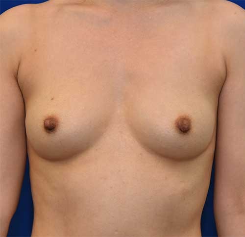 Breast Augmentation Patient 3 before and after - before