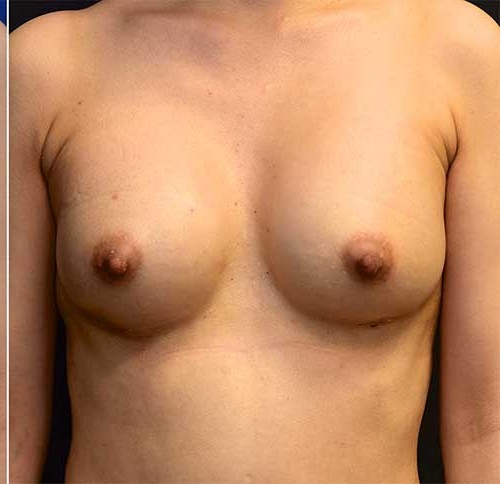 Breast Augmentation Patient 4 before and after - after