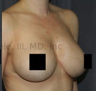 Breast Augmentation Revision before and after - after