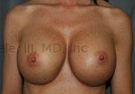 Breast Augmentation Revision before and after - after