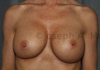Breast Augmentation Revision before and after - before