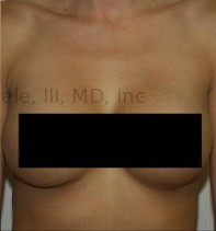 Breast Augmentation Revision before and after - after