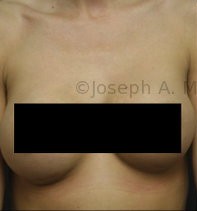 Breast Augmentation Revision before and after - before