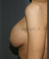 Breast Augmentation Revision before and after - before