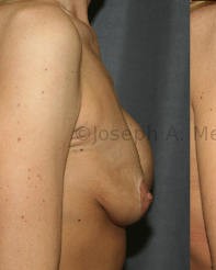 Breast Augmentation Revision before and after - before