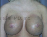 Breast Augmentation Revision before and after - after