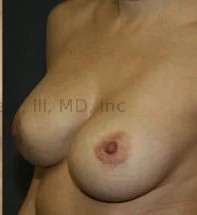 Breast Augmentation Revision before and after - after
