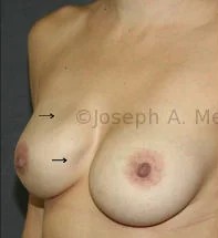 Breast Augmentation Revision before and after - before