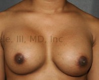 Breast Augmentation Revision before and after - after