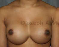 Breast Augmentation Revision before and after - before