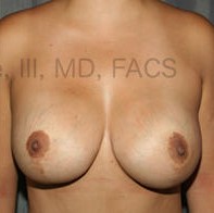 Breast Augmentation Revision before and after - after
