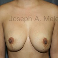 Breast Augmentation Revision before and after - before
